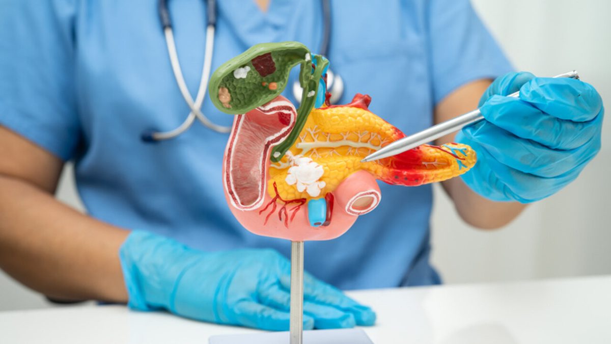 Tumore del pancreas, sviluppato un esame del sangue per la diagnosi precoce
