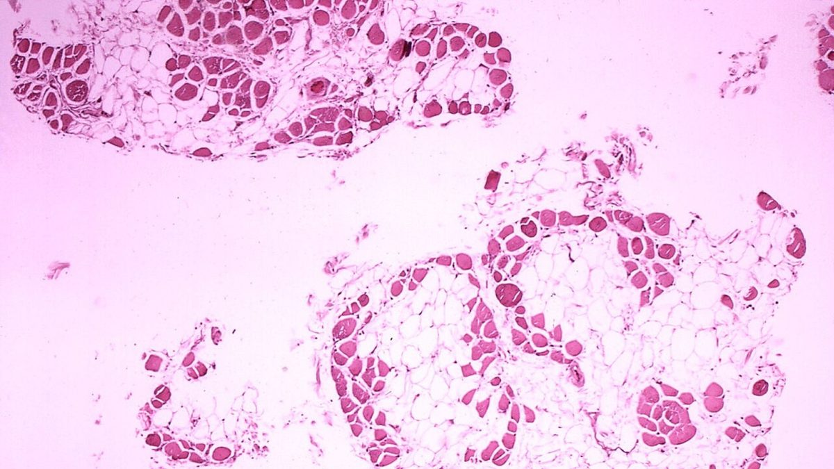 Distrofia muscolare Duchenne, nuovo farmaco migliora la qualità di vita