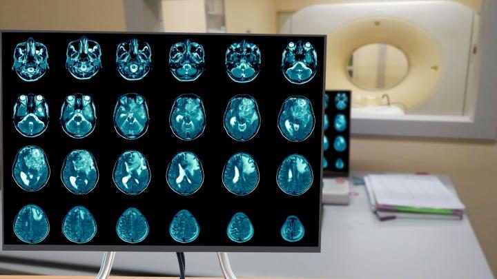 Badacze sprawdzili, co dzieje się w mózgu miesiąc po przyjęciu psylocybiny