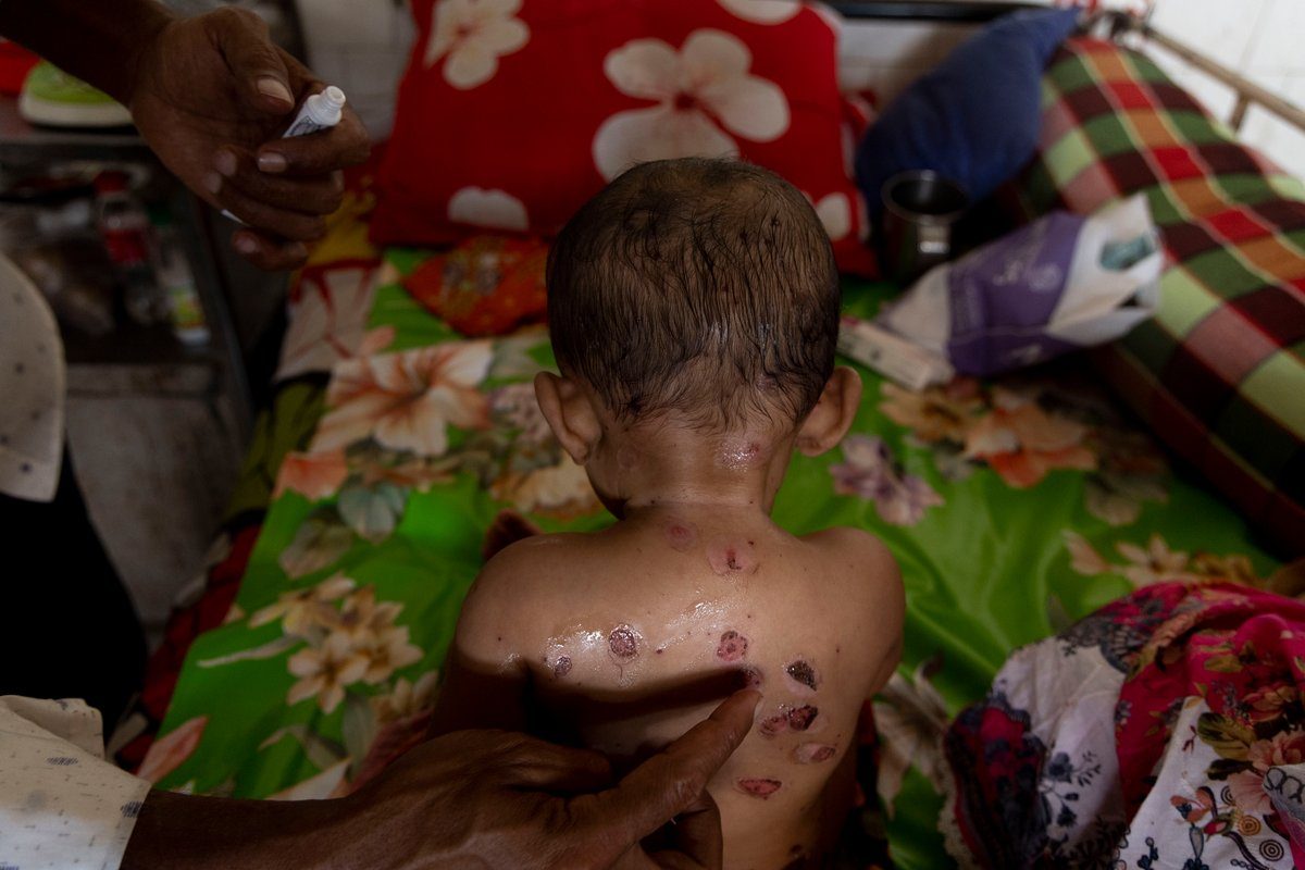 Why Bangladesh’s measles outbreak is a cautionary tale for the U.S.