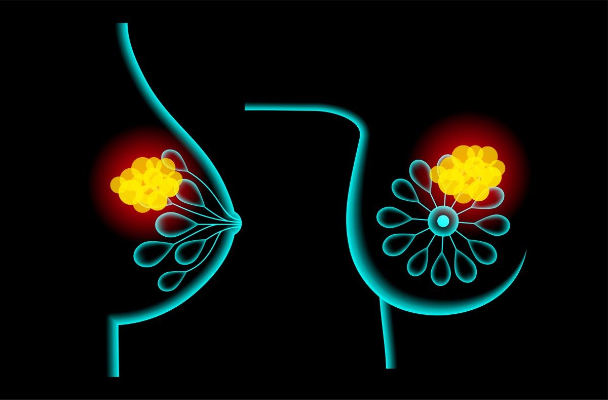 New Drug Approved for Advanced Breast Cancer After Other Treatments Fail