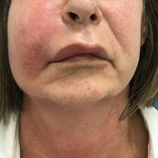 Op het fillerspreekuur kunnen mensen terecht bij wie fillerbehandeling is mislukt: ‘Een vrouw had haar fillers bij een…
