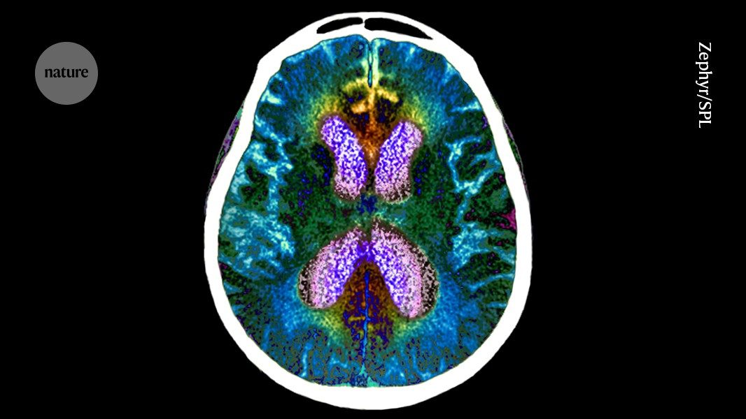 Cognitive resilience helps to predict Alzheimer’s dementia