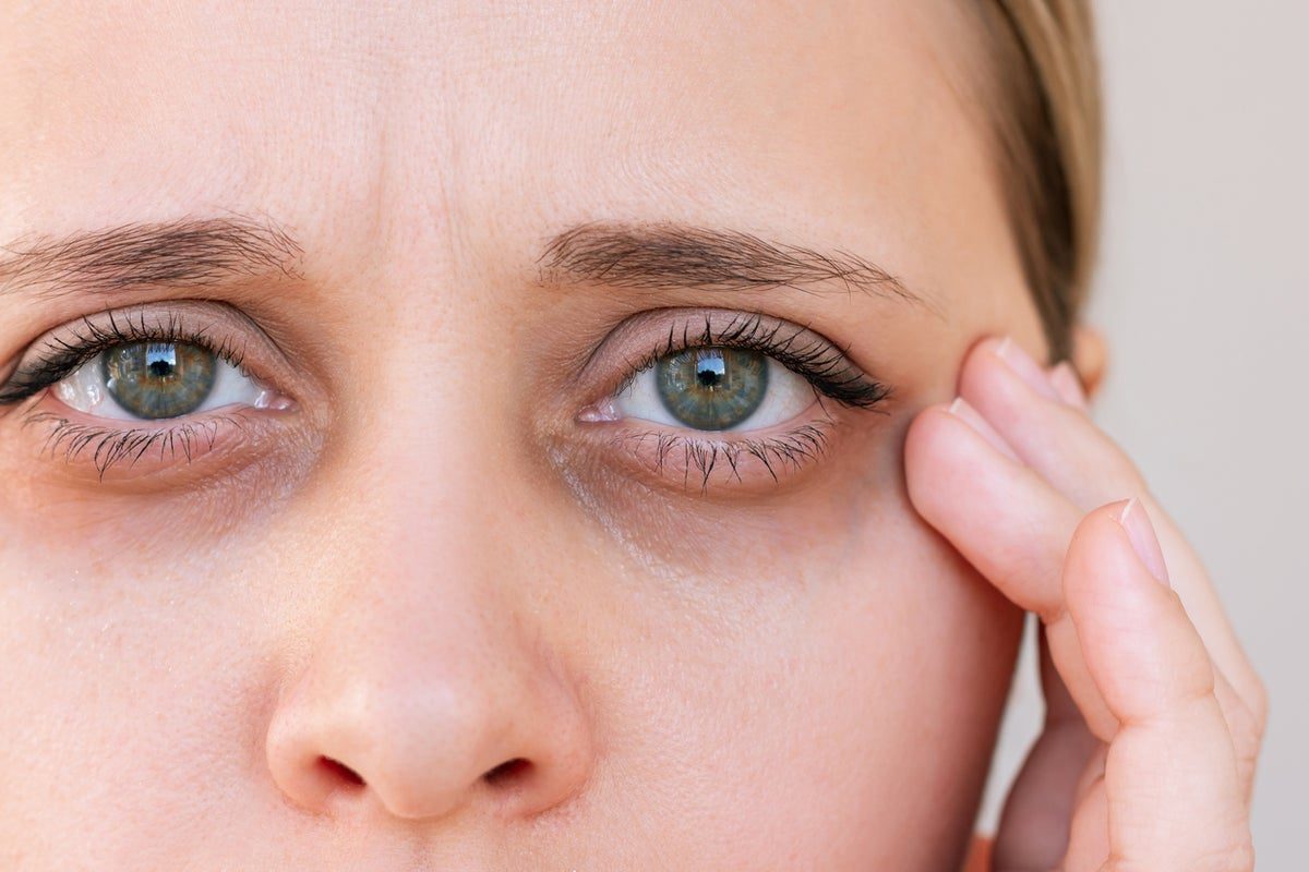 What is ‘ferritin face’ – and can my skin really show the signs of low iron?