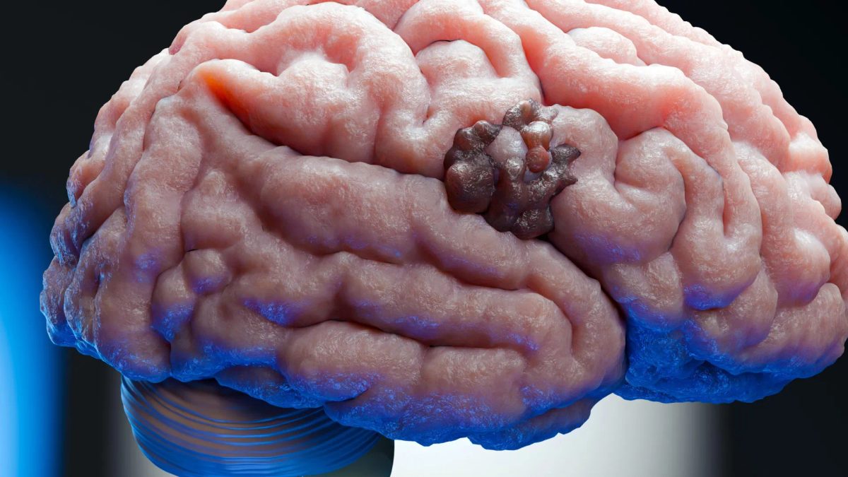 Scientists find a weak spot in one of the deadliest brain cancers