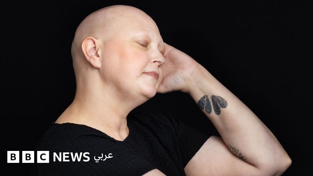 "تساقط شعري بسبب العلاج الكيميائي لا يحدّد هويتي... بل هو رمز لقوّتي"