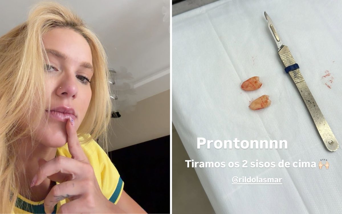 Virginia faz cirurgia para retirar sisos após sentir muita dor