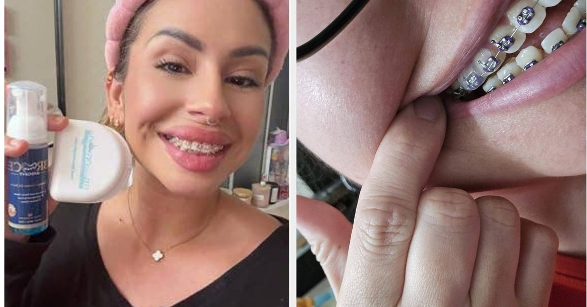 15 Products People With Braces Swear By