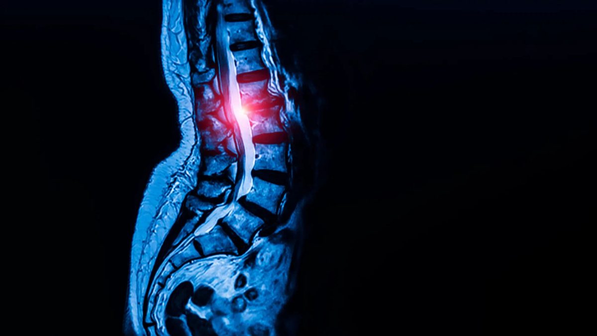 Hidden stem cells may be fueling spinal stenosis