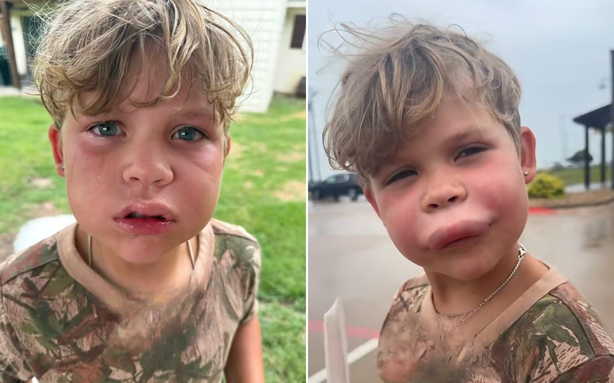 Mom Didn't Think Son's Wasp Sting Was 'Big Deal,' Then The Swelling Began