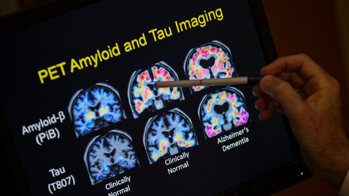 Want to lower your risk of dementia? It doesn't involve a blood test