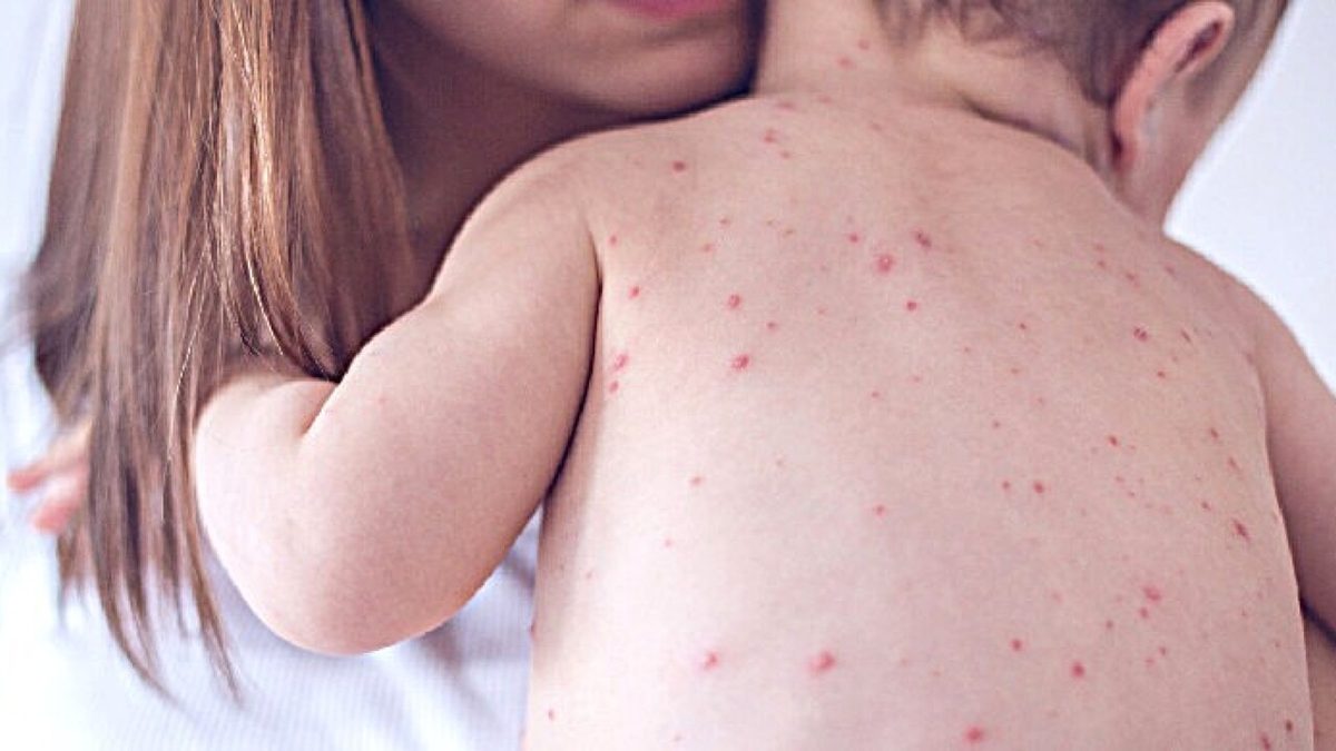 Ecdc, '2.339 casi di morbillo nell'Ue in un anno e nessun decesso'
