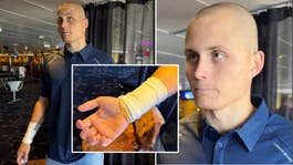John Dahlström berättar om skräckskadan: ”Vill knappt tänka på det”