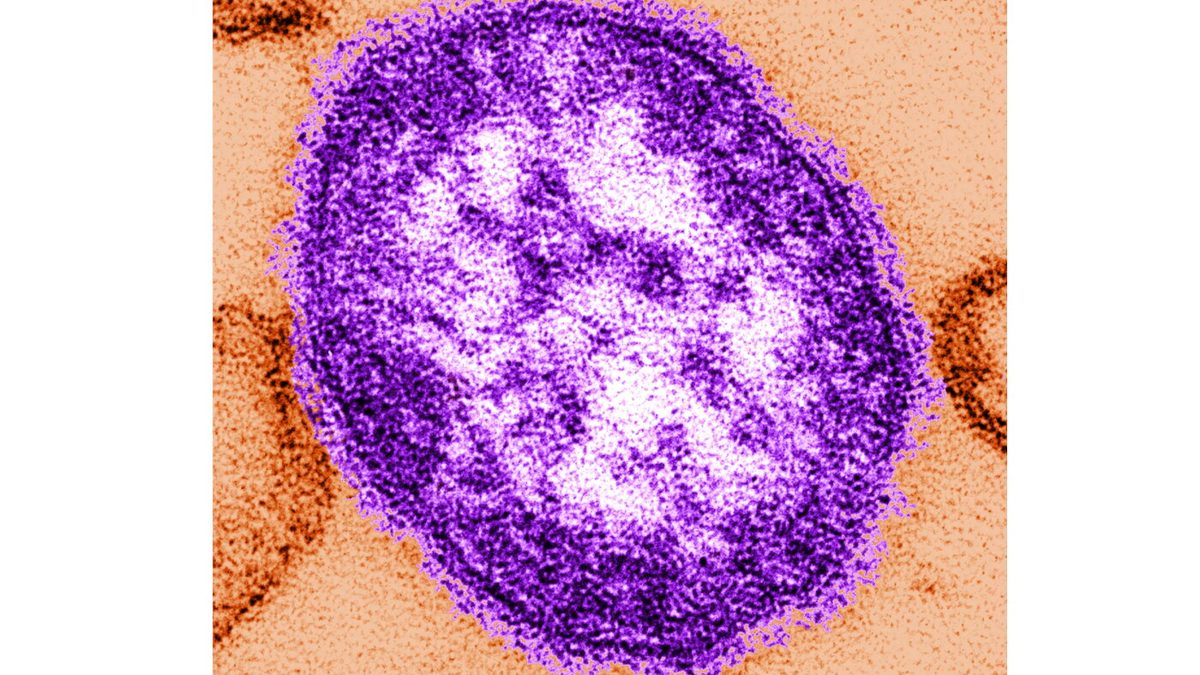 Pennsylvania says an unvaccinated woman has died from measles-related complications